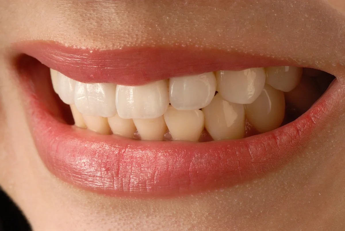 Hollywood Smile: Veneers vs. Whitening and When to Choose Each